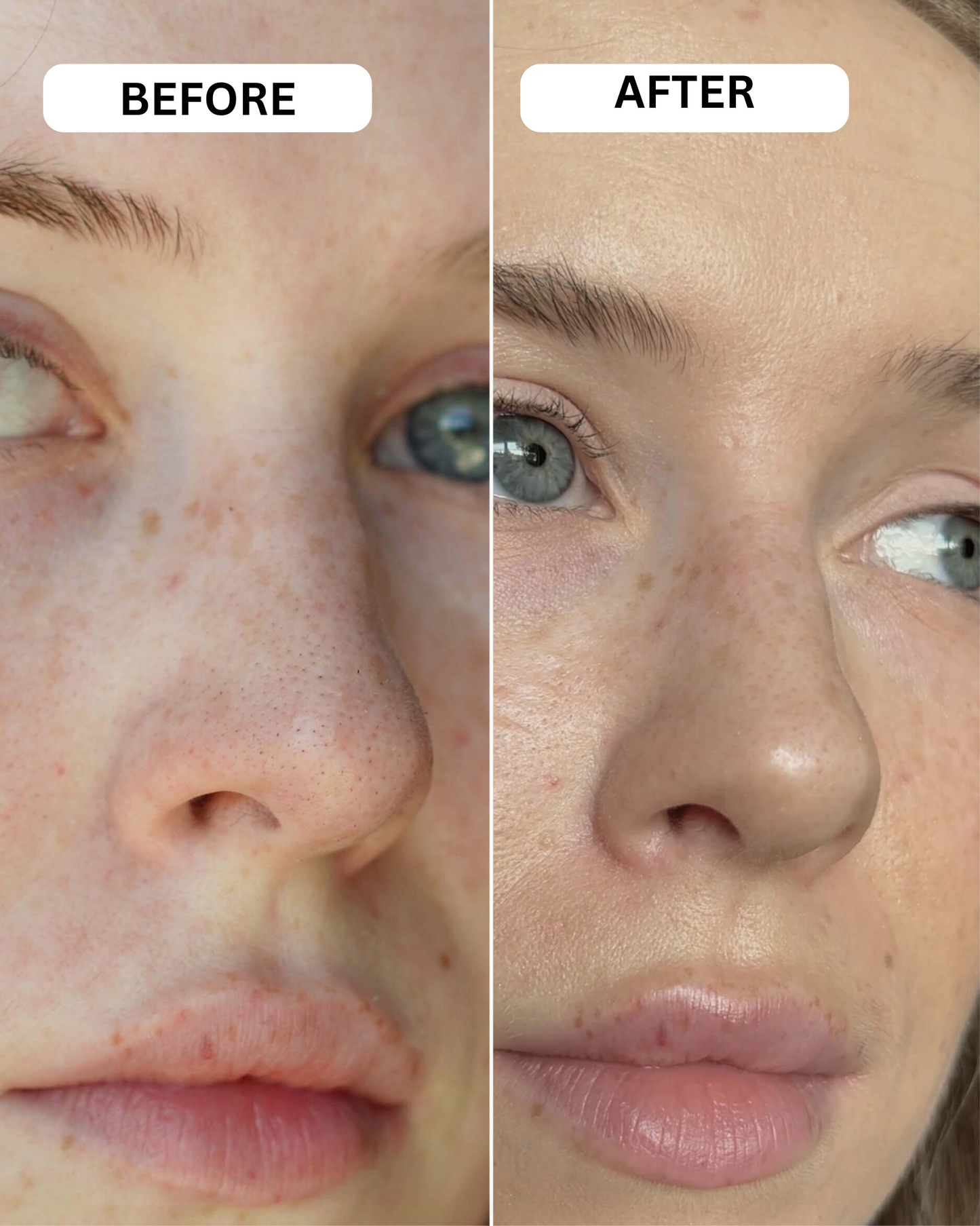 Easy Clear Blackhead Patches